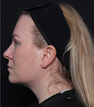 Genius Microneedling patient before treatment