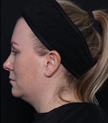 before treatment