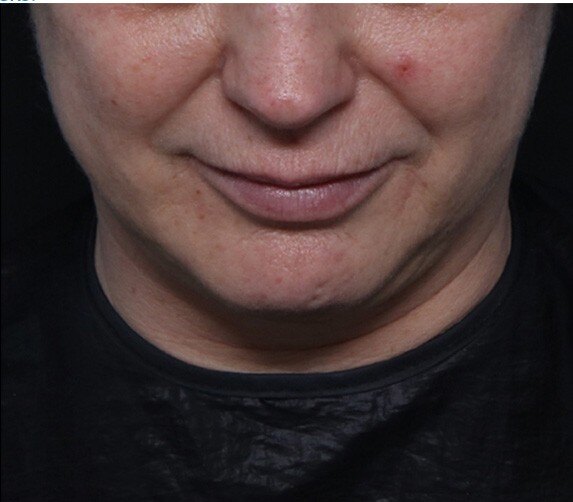 Genius Microneedling patient before treatment