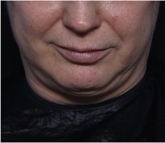 before treatment