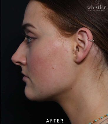 Genius Microneedling patient before treatment