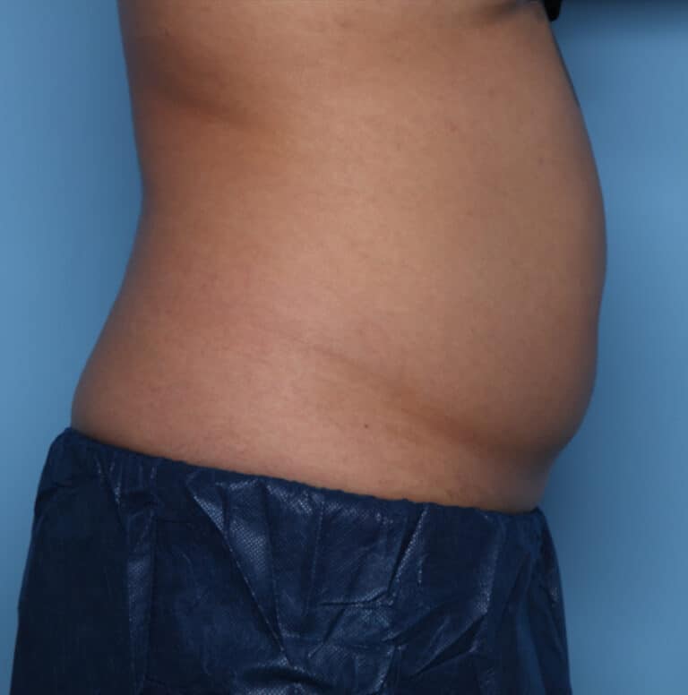 before treatment