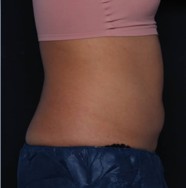 Genius Microneedling patient before treatment
