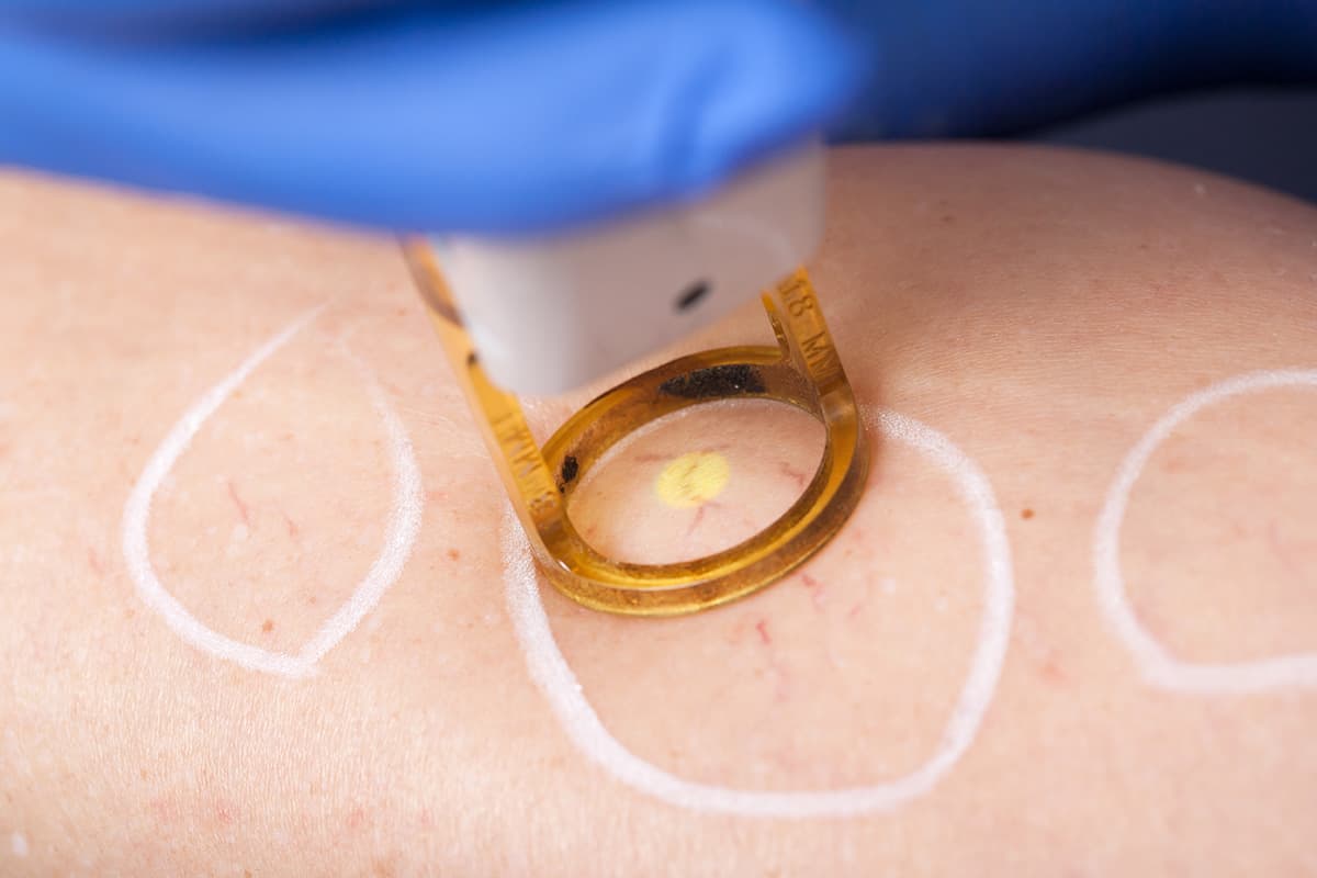 ClearV™ Laser Vein Removal for you in Whistler