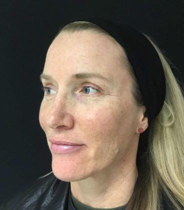 Genius Microneedling patient before treatment