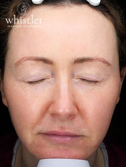 Genius Microneedling patient before treatment