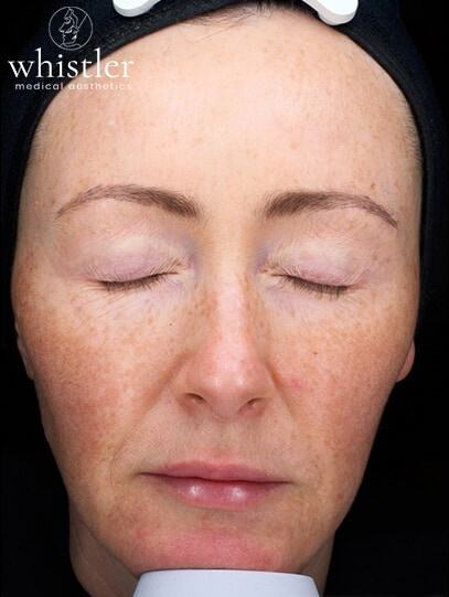 before treatment