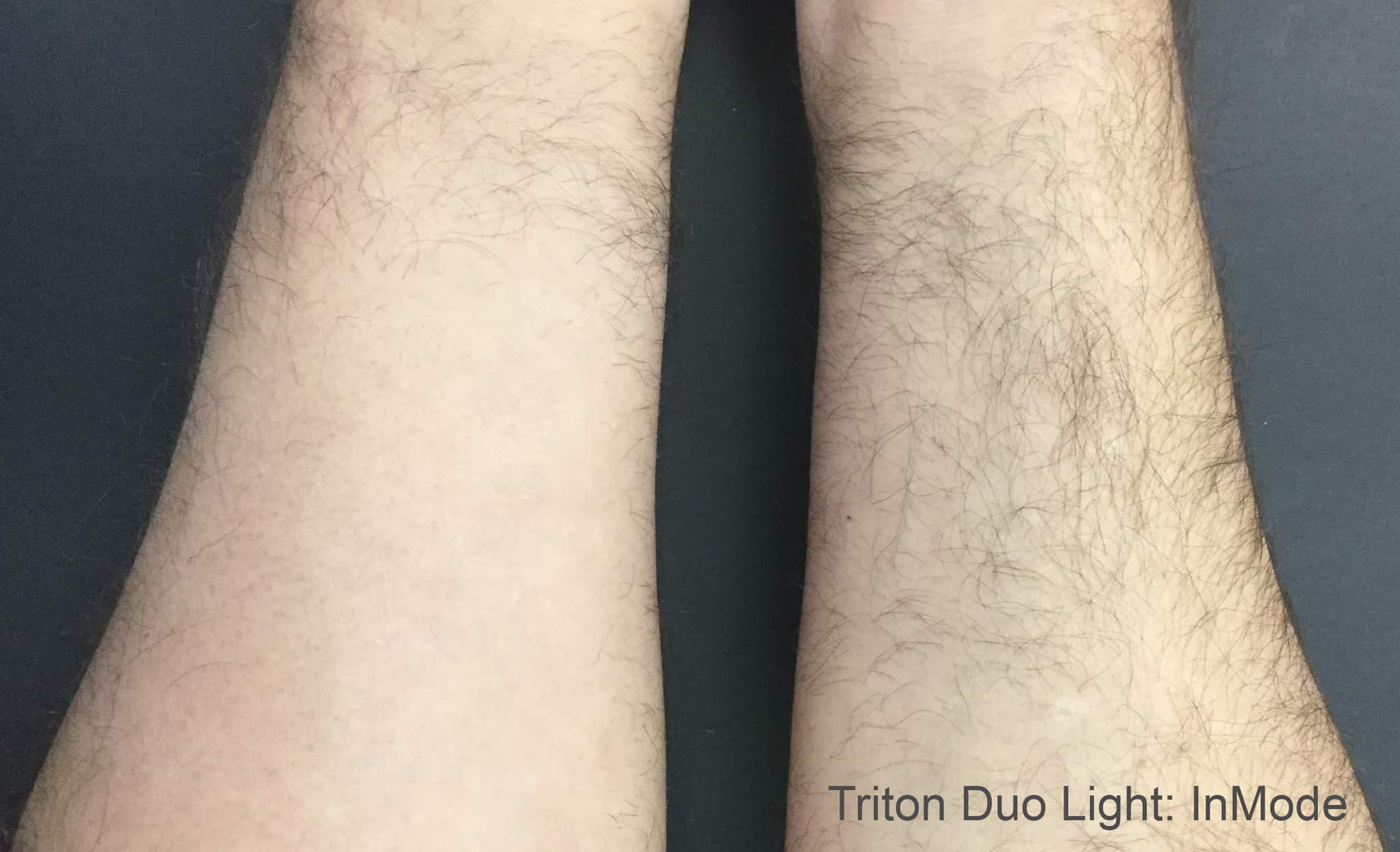 before treatment