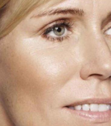 Genius Microneedling patient before treatment