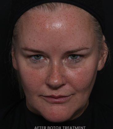 Genius Microneedling patient before treatment