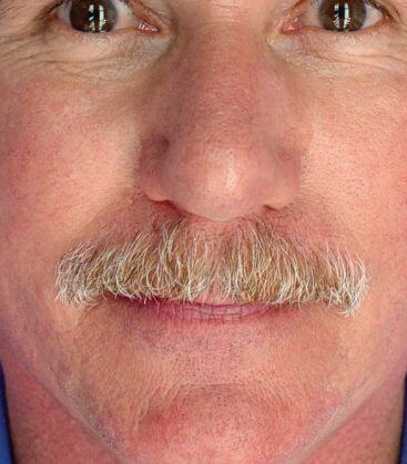 Genius Microneedling patient before treatment