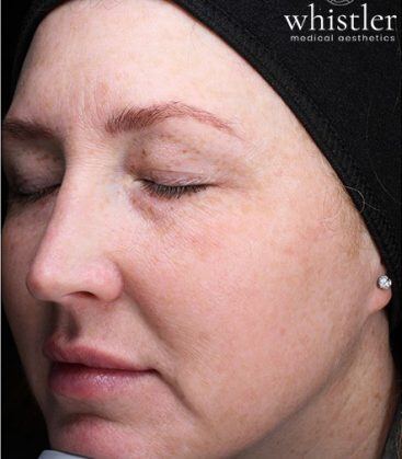 Genius Microneedling patient before treatment