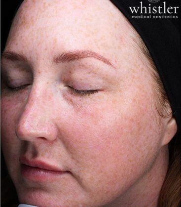 before treatment