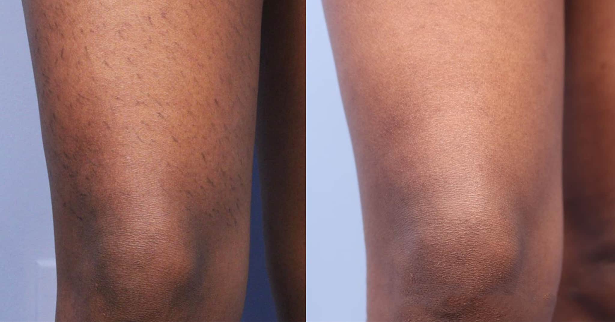 Genius Microneedling patient before treatment