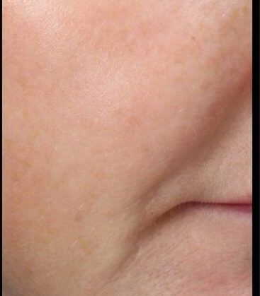 Genius Microneedling patient before treatment