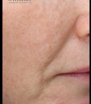 before treatment