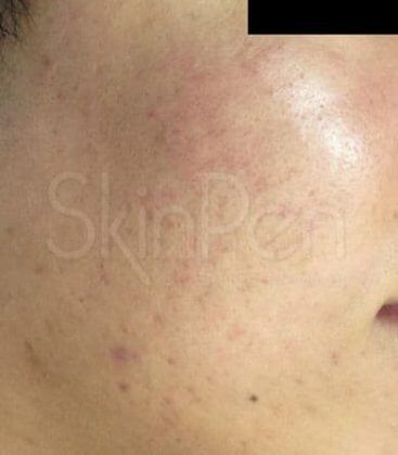 Genius Microneedling patient before treatment