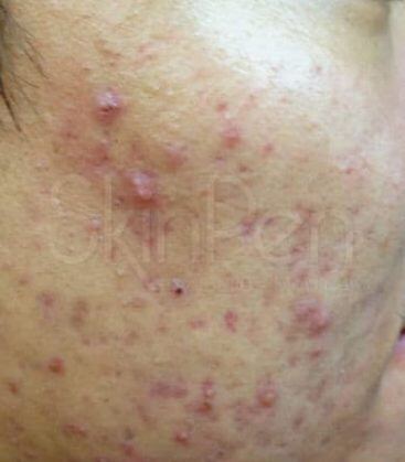 before treatment
