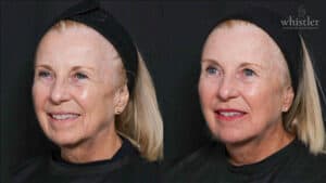 linda ha16 side profile before after