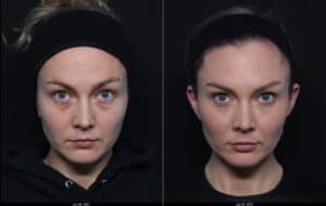 under eye correction
